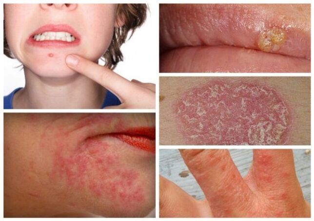 Allergies and skin diseases are signs of parasites in the body. 
