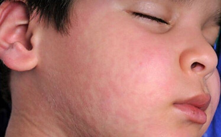 Allergic rashes on the skin a symptom of the presence of parasitic worms in the body